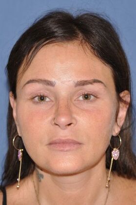 Endoscopic Browlift: Endoscopic Browlift and Facelift at 6 months - After