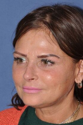 Endoscopic Browlift: Endoscopic Browlift and Facelift at 6 months - Before
