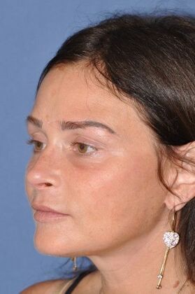 Endoscopic Browlift: Endoscopic Browlift and Facelift at 6 months - After