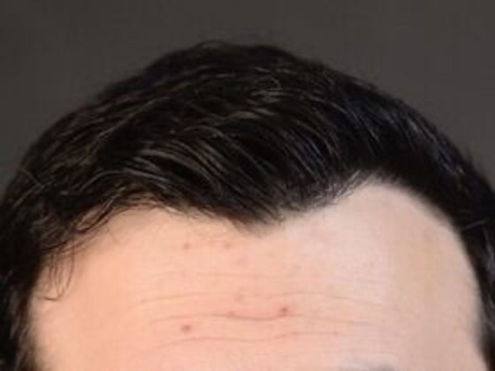 Corrective Hair Restoration Case 3 - After