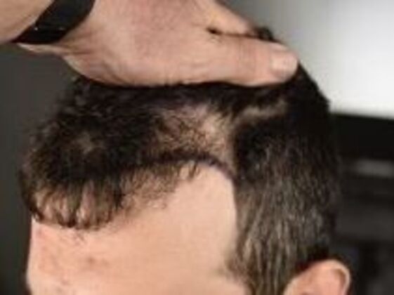 Corrective Hair Restoration: Case 3 - Before