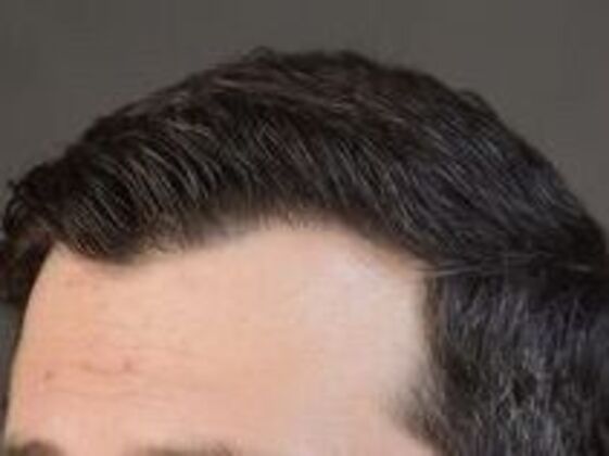 Corrective Hair Restoration: Case 3 - After