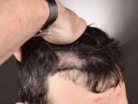 Corrective Hair Restoration: Case 3 - Before