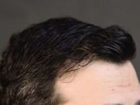 Corrective Hair Restoration: Case 3 - After