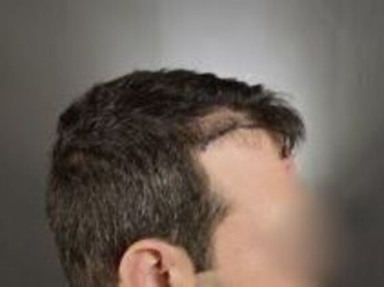Corrective Hair Restoration: Case 3 - Before