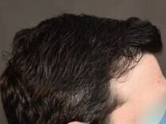 Corrective Hair Restoration: Case 3 - After