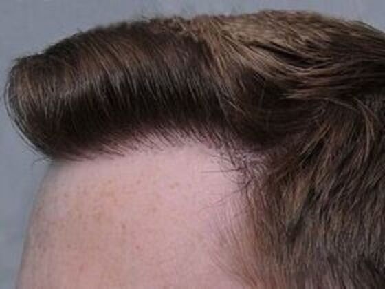 Corrective Hair Restoration: Case 4 - After