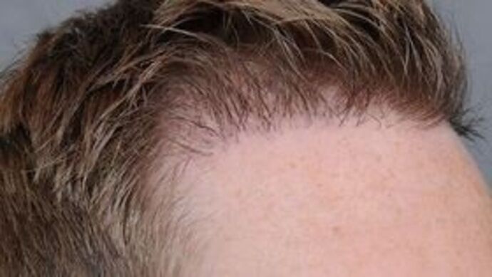 Corrective Hair Restoration: Case 4 - Before
