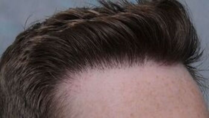 Corrective Hair Restoration: Case 4 - After