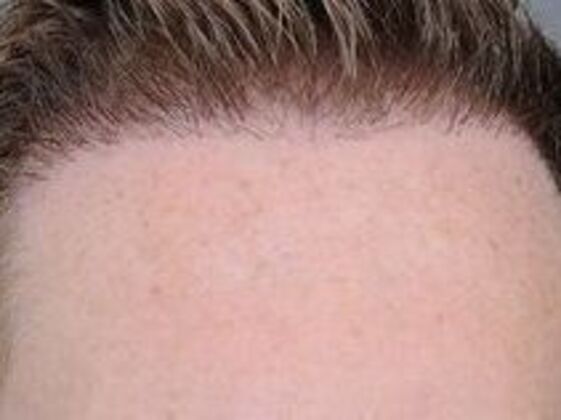 Corrective Hair Restoration: Case 4 - Before