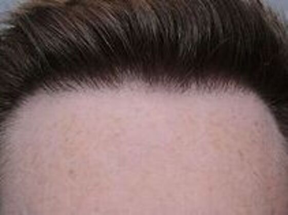 Corrective Hair Restoration: Case 4 - After
