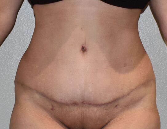 Tummy Tuck (Abdominoplasty): Case 415 - After