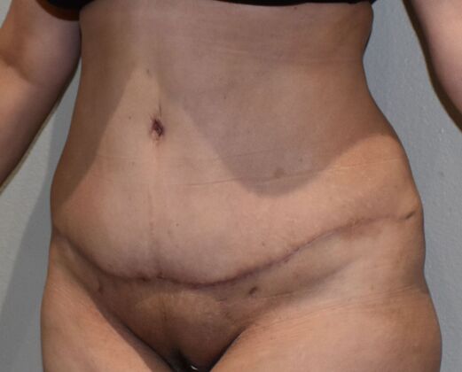 Tummy Tuck (Abdominoplasty): Case 415 - After