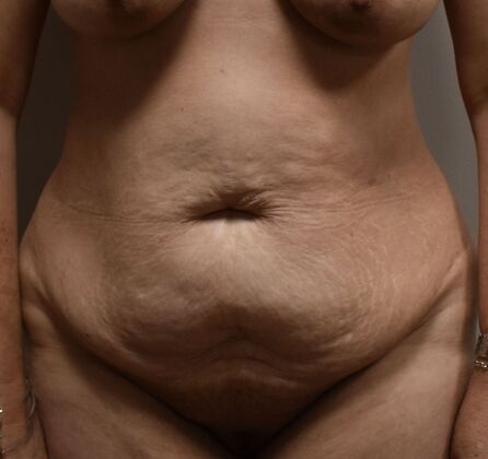 Tummy Tuck (Abdominoplasty): Case 415 - Before