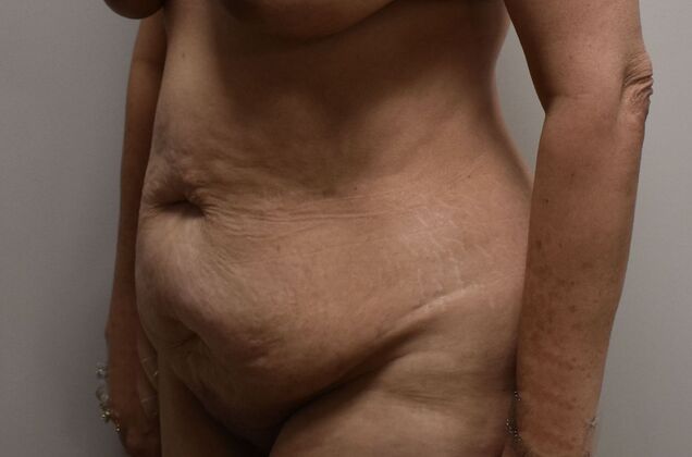 Tummy Tuck (Abdominoplasty): Case 415 - Before