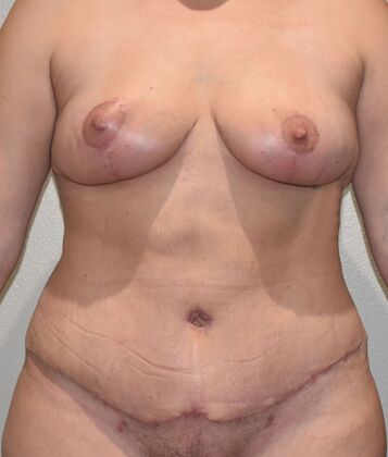 Mommy Makeover Case 270 - After