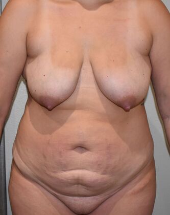 Mommy Makeover Case 270 - Before