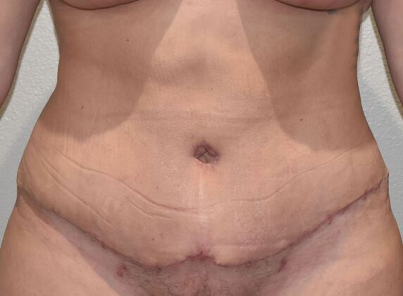 Tummy Tuck (Abdominoplasty): Case 416 - After