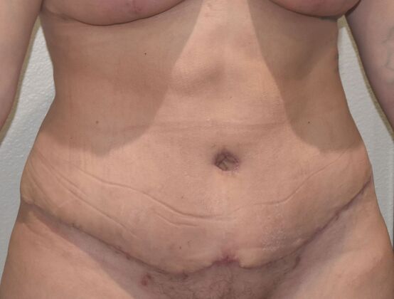 Tummy Tuck (Abdominoplasty): Case 416 - After