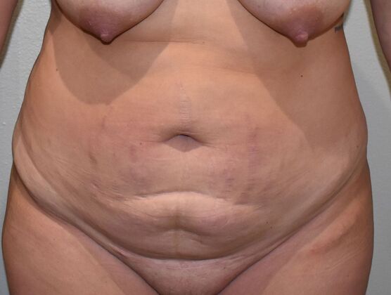 Tummy Tuck (Abdominoplasty): Case 416 - Before