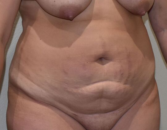 Tummy Tuck (Abdominoplasty): Case 416 - Before