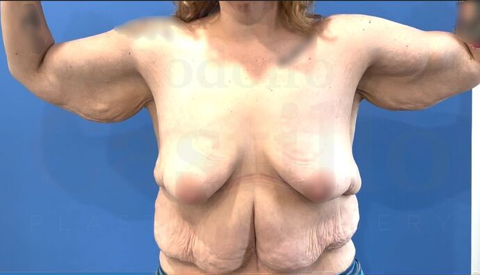 Upper Body Lift Extended Breast lift + Extended Arm Lift + Reverse Abdominoplasty + Posterior Upper Body Lift - Before
