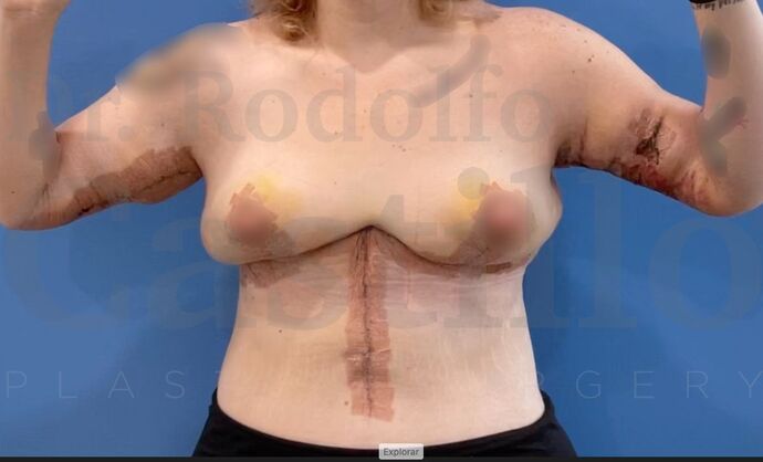 Upper Body Lift Extended Breast lift + Extended Arm Lift + Reverse Abdominoplasty + Posterior Upper Body Lift - After