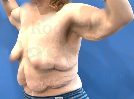 Upper Body Lift: Extended Breast lift + Extended Arm Lift + Reverse Abdominoplasty + Posterior Upper Body Lift - Before