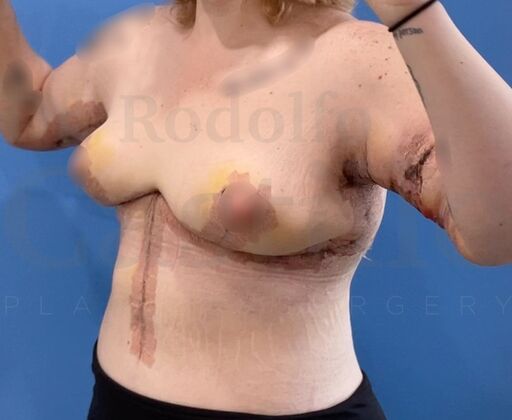 Upper Body Lift: Extended Breast lift + Extended Arm Lift + Reverse Abdominoplasty + Posterior Upper Body Lift - After