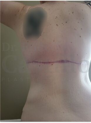 Upper Body Lift: Extended Breast lift + Extended Arm Lift + Reverse Abdominoplasty + Posterior Upper Body Lift - After 2 months