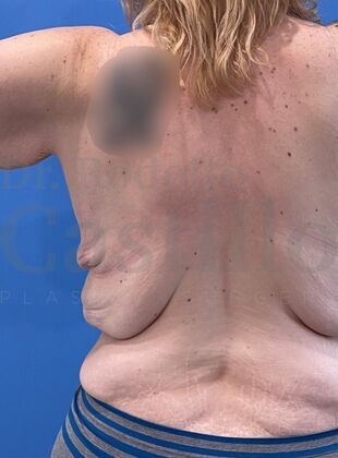 Upper Body Lift: Extended Breast lift + Extended Arm Lift + Reverse Abdominoplasty + Posterior Upper Body Lift - Before