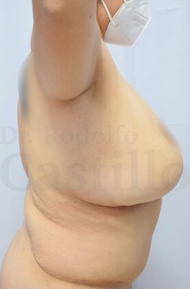 Upper Body Lift: Post-Bariatric Patient with previous breast lift - Before