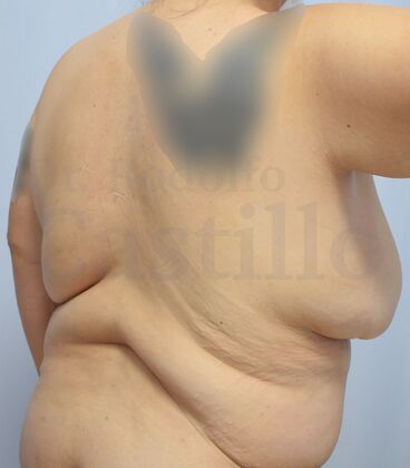 Upper Body Lift: Post-Bariatric Patient with previous breast lift - Before