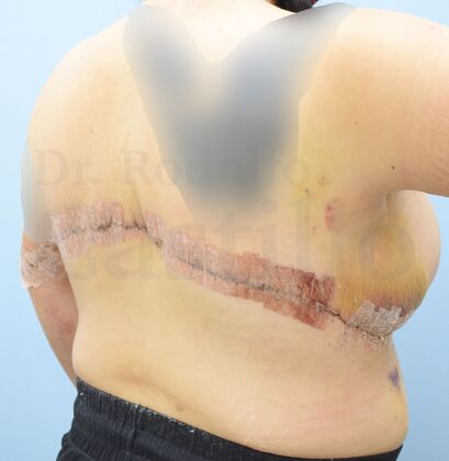 Upper Body Lift: Post-Bariatric Patient with previous breast lift - After