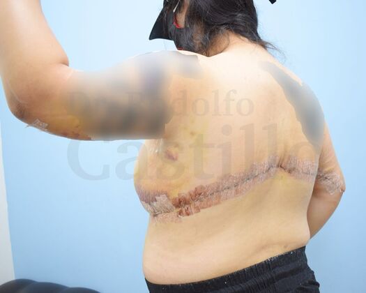Upper Body Lift: Post-Bariatric Patient with previous breast lift - After