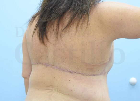 Upper Body Lift: Upper Body Lift: Extended Breast lift and Arm + Posterior upper body lift - After