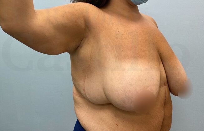 Upper Body Lift Upper Body Lift: Extended Breast lift and Arm + Posterior upper body lift - Before