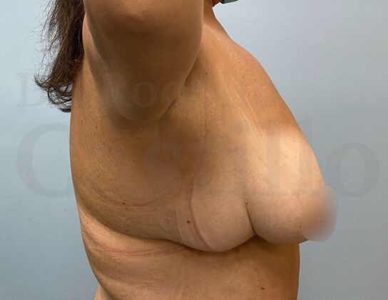 Upper Body Lift: Upper Body Lift: Extended Breast lift and Arm + Posterior upper body lift - Before