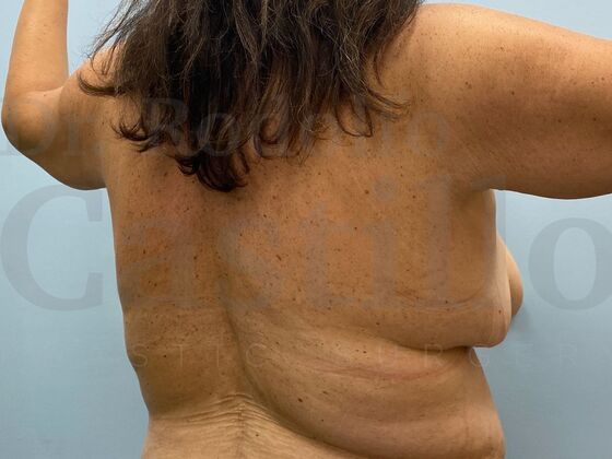 Upper Body Lift: Upper Body Lift: Extended Breast lift and Arm + Posterior upper body lift - Before