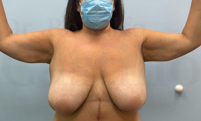 Upper Body Lift: Upper Body Lift: Extended Breast lift and Arm + Posterior upper body lift - Before