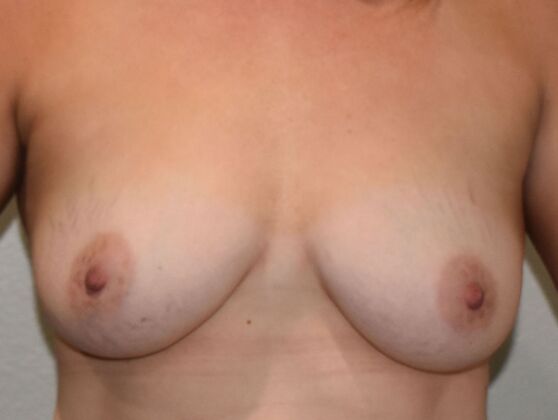 Breast Augmentation Case 741 - Before
