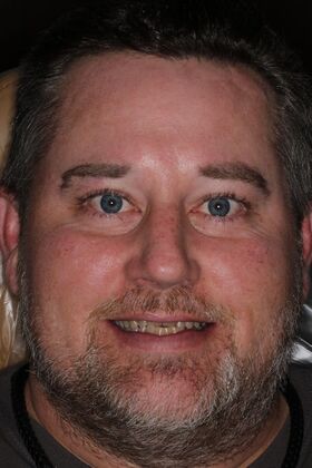 Veneers Case 35 - Before