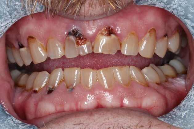 Veneers: Case 35 - Before