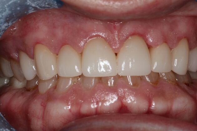 Veneers: Case 35 - After