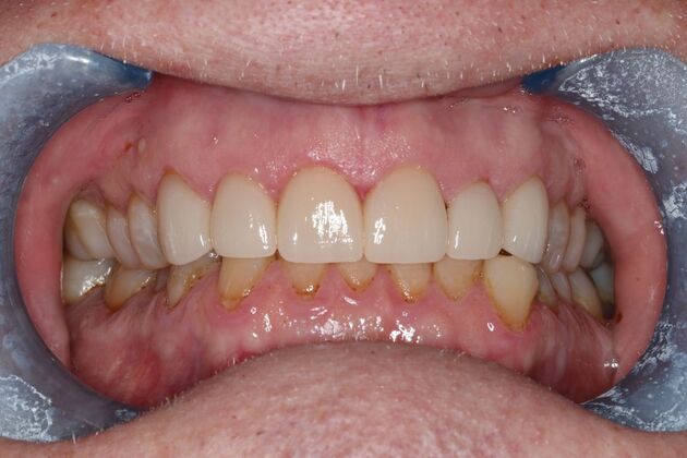 Veneers: Case 33 - After