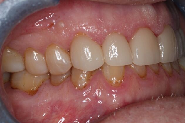 Veneers: Case 33 - Before
