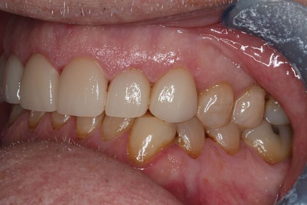 Veneers: Case 33 - After