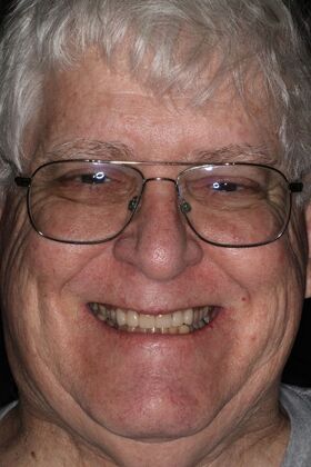 Veneers Case 33 - After