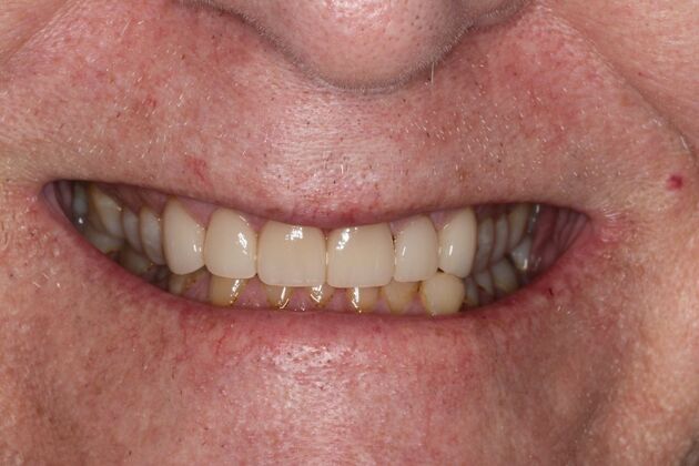 Veneers: Case 33 - After