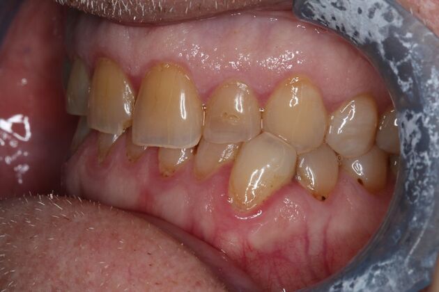Veneers: Case 33 - After